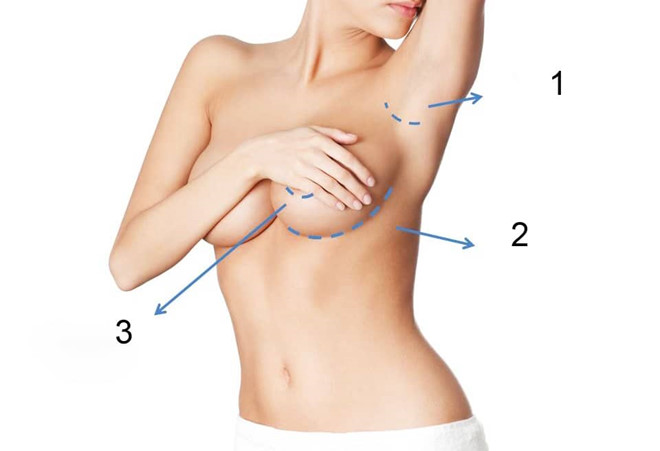 Nâng ngực nên chọn đường mổ nào?